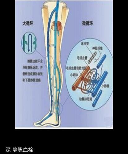 (1)适应证:各种原因引起的局限性髂股静脉血栓形成;急性,亚急性血栓