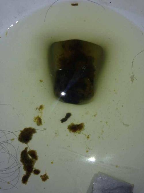 这是结肠炎还是肠癌?前几天拉过深色血和粪便不黏连 大多是什么可能?