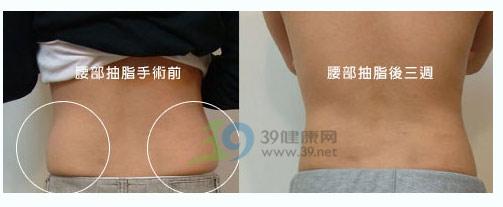 四个腰腹吸脂案例