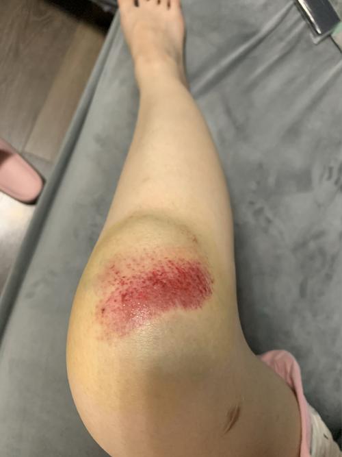 屋漏偏逢连夜雨 骑电瓶车摔一跤…伤口里面都是沙子.