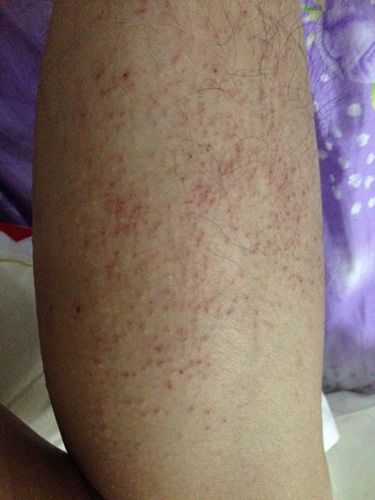 腿上不知道起的红点还痒是为啥