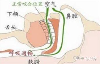 另外,打呼噜,张口呼吸会使儿童还没有长大的"娃娃脸"出现牙齿不