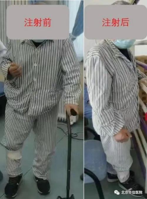 脑卒中后肢体痉挛,半身不遂?来神经内科看看!