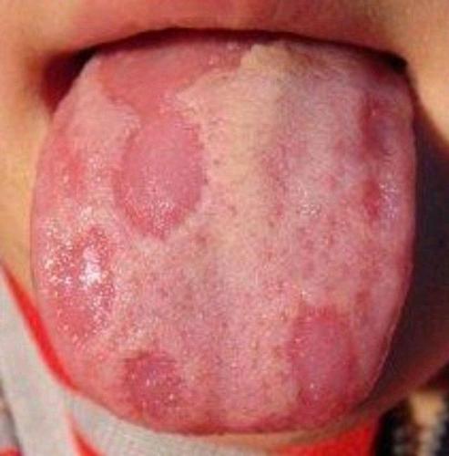 5,镜面舌见于缺铁性贫血,急性贫血及慢性萎缩性胃炎的患者.