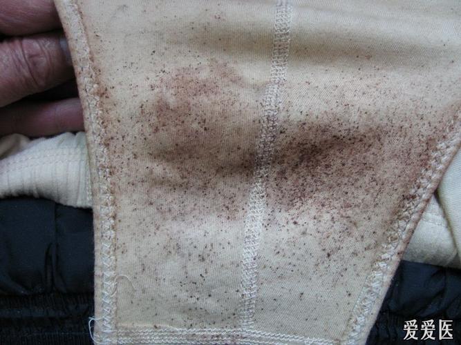 外阴瘙痒----阴虱