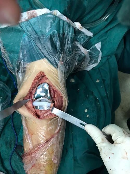 术中假体植入后.