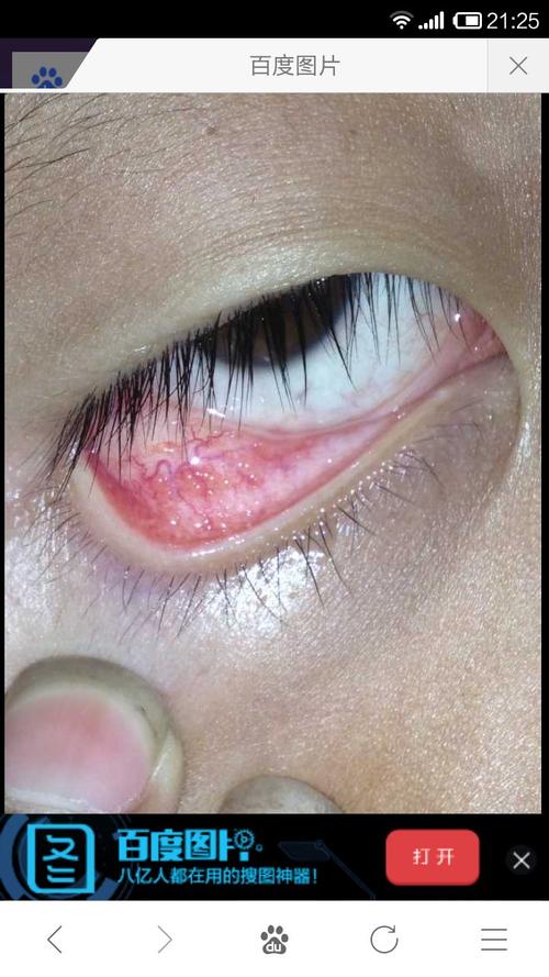 小孩下眼皮里面有很多似小水疱的小疙瘩,有点痒是怎麽