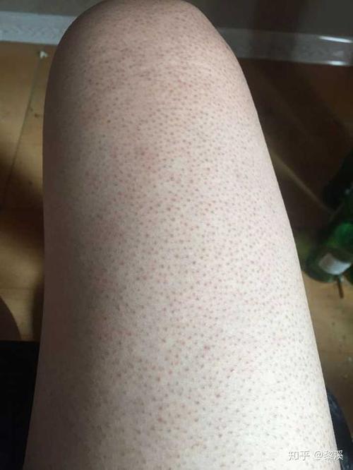 毛囊角质化(鸡皮肤)是否无法改善?