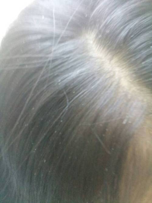 头上有脂肪粒,白色的,形状不是小圆点