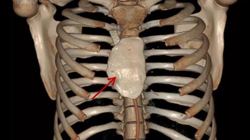 洗澡不经意发现胸骨凸起?竟是肿瘤!吓得我赶紧摸一下