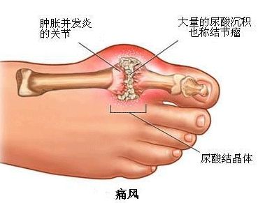 痛风       痛风是由嘌呤代谢紊乱造成的炎症反应,长期的尿酸盐结晶