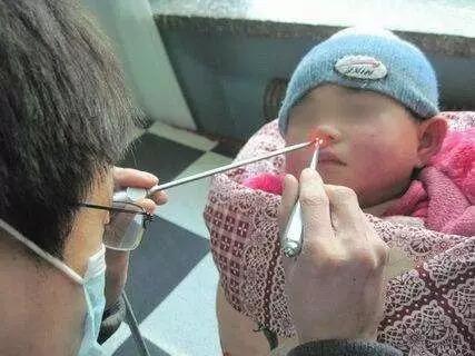 张医生说,科室里每个月都会碰到几十例宝宝鼻腔异物的病例,最多的时候