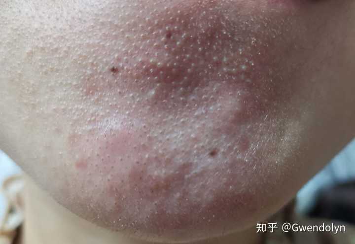 典型的假黑头,皮脂腺粗大!