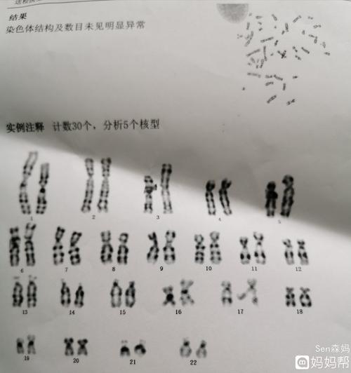 羊水穿刺能看出男女吗