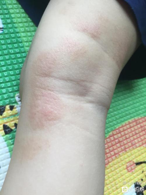 关于特异性皮炎的一些思考