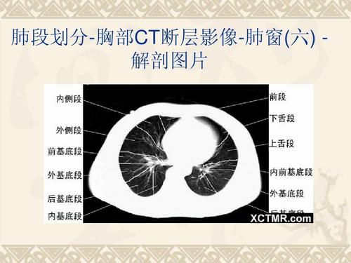 肺段划分-胸部ct断层影像-肺窗(六) 解剖图片