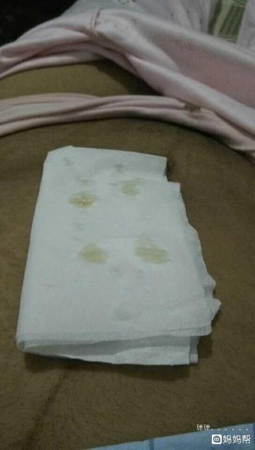 剖腹产伤口上济出脓