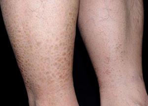 鱼鳞病发病有哪些症状特点