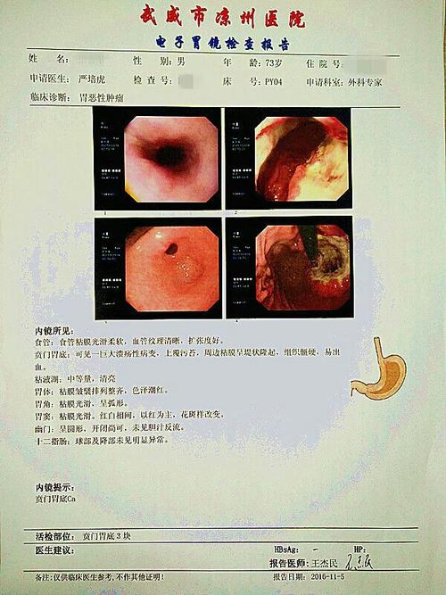 胃底贲门有一巨大溃疡性病变,活检报告贲门高分化腺癌,印戒细胞为主