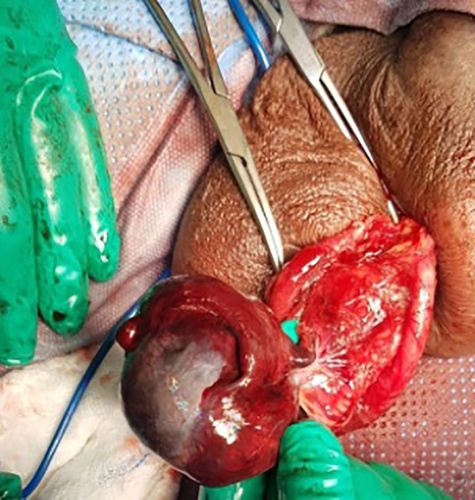 术中发现:左侧睾丸外观暗淡,附睾黑色坏疽