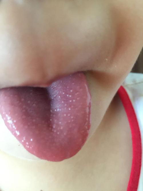 大家帮忙看看,三岁男童舌头上长的小白泡是怎么回事?