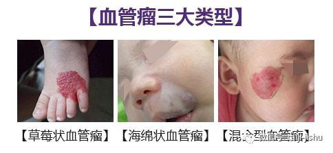 一般出生时已存在,最初颇似草莓状毛细血管瘤,但很快扩展至皮肤范围以