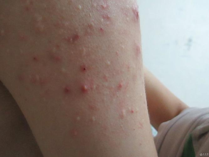 希望各位专家大神可以帮忙看一下这是什么皮肤病(好些