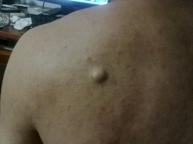 临床上皮下脂肪瘤的治疗方法_肿瘤科_阿里康网