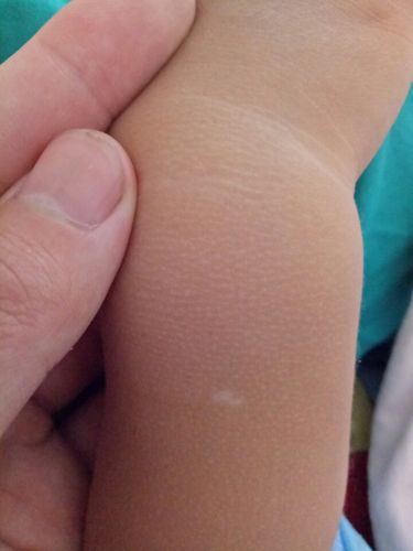 15:43                              一种是白色糠疹,这种皮肤疾病是