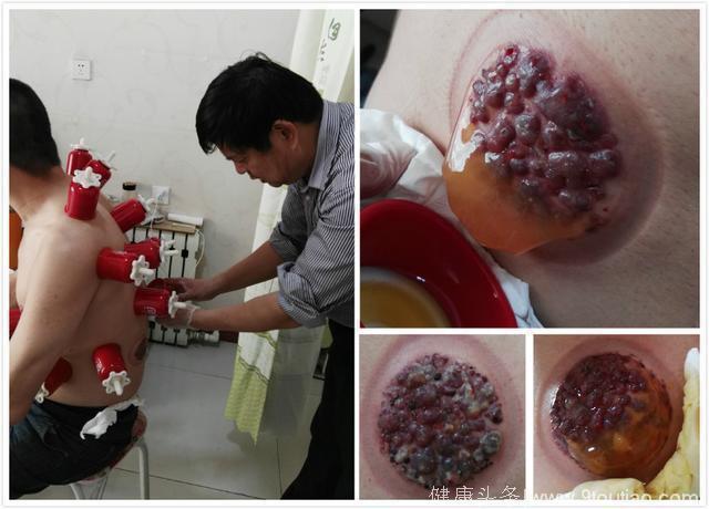 拔罐,原来不简单——临淄心和堂拔罐的探索与实践