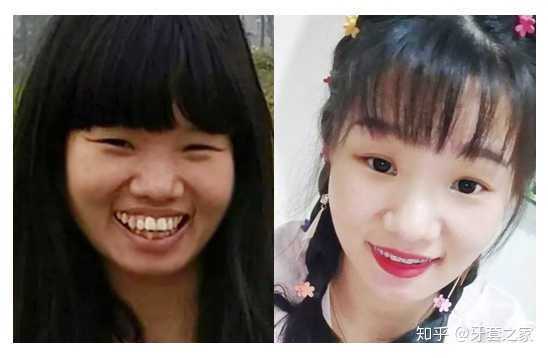 拥有一口龅牙是什么体验