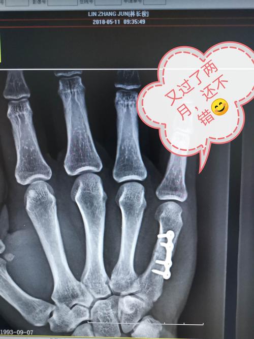 果然术后三个月来复查,要拍片看看,好的,骨折断端骨痂明显,这下患者