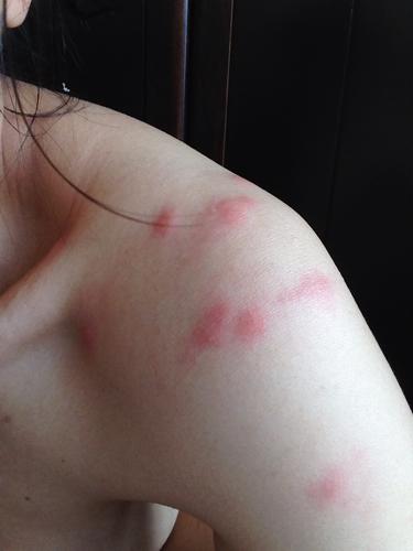 问:不知道是被虫咬了还是过敏大家帮忙看一下吧刚开始很痒红一片第二