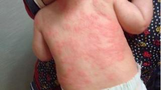 拜拜了,湿疹,拜拜了,红疙瘩,拜拜了,皮肤过敏