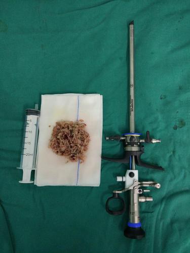 切除增生前列腺组织约70克