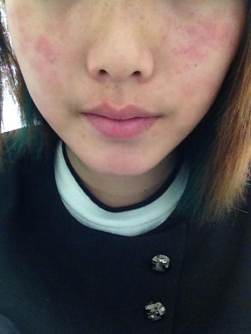 这不是个问题 类似病状换一换 1 问:你好,想问一下用化妆品过敏了,脸