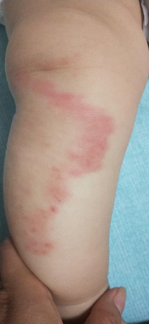 七个月婴儿小腿过敏性湿疹已经一个月了,一直往外扩散