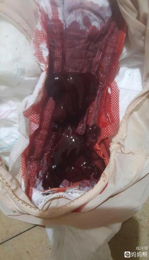 怀孕50天出血有血块,以为流产了,喝了一