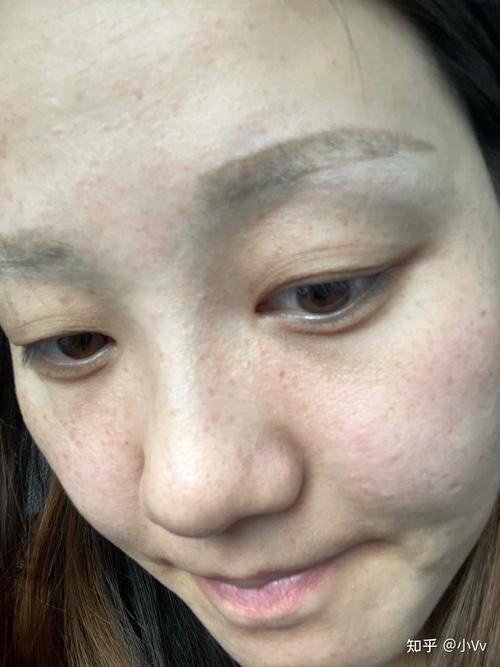 药水点斑真实图片不知道算不算是成功了反正身边人都说我这个成功了