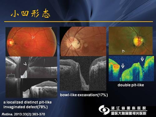 视盘小凹相关黄斑疾病