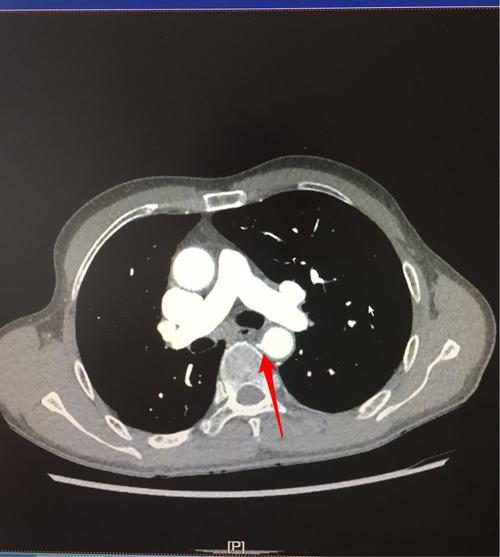 术前cta支气管动脉定位,我们很幸运,ct室双期扫描,256排ct实时给