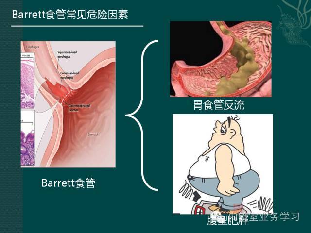 barrett食管相关知识