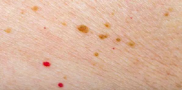 皮肤上有红点,是什么?