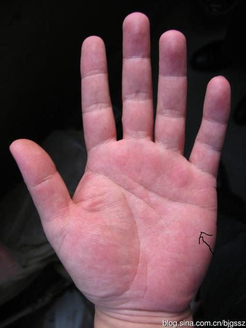 重度脂肪肝的症状