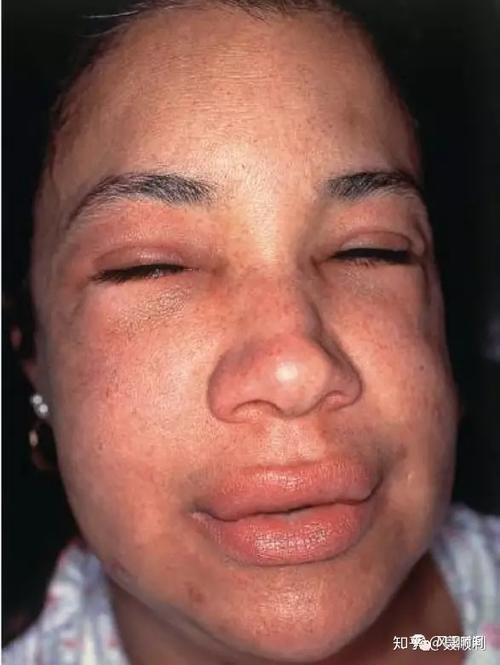 眼眶,唇的血管性水肿,没有明显皮肤颜色改变