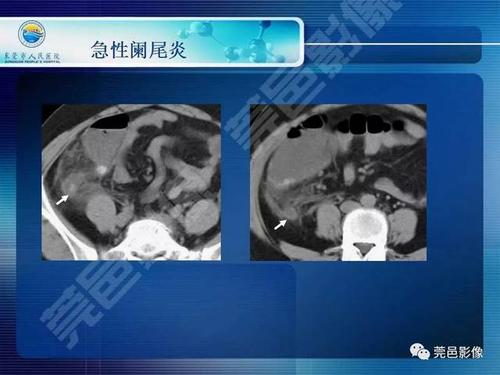 急性阑尾炎的ct表现