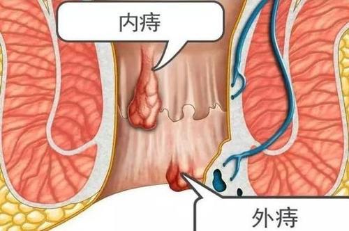 怎么正确判断自己得了痔疮,根治痔疮最好的办法?