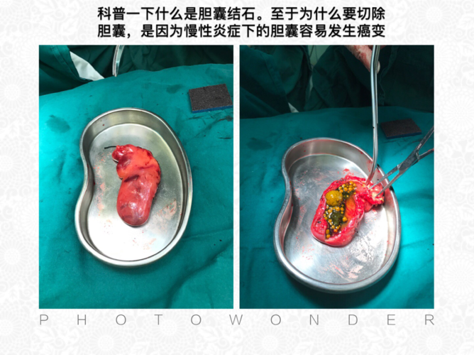 胆囊结石长什么样子?为什么要切除胆囊?