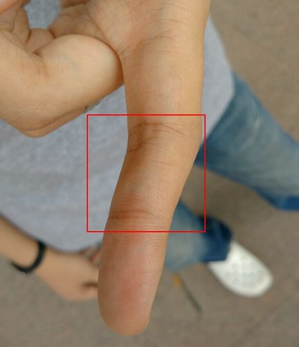 手指血管鼓起硬化