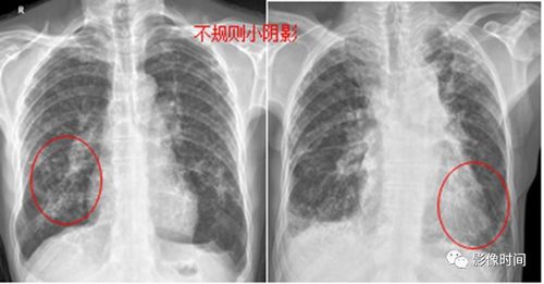一种让人"跪着死去"的肺部疾病